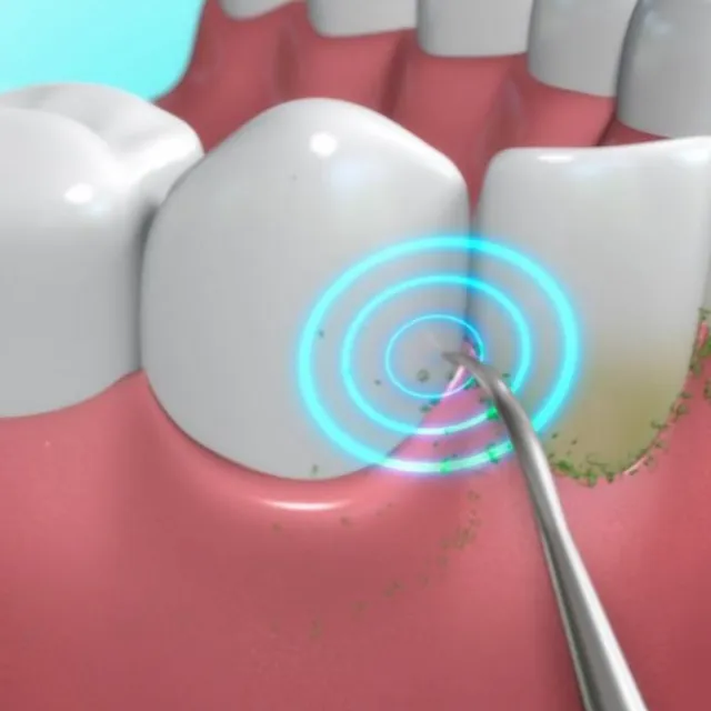Ultrazvukové zariadenie na čistenie zubov