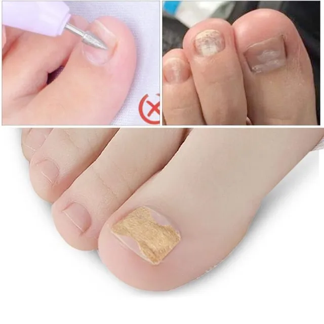 Bezlepidlové náplasti na nehty proti zarůstání (10ks)