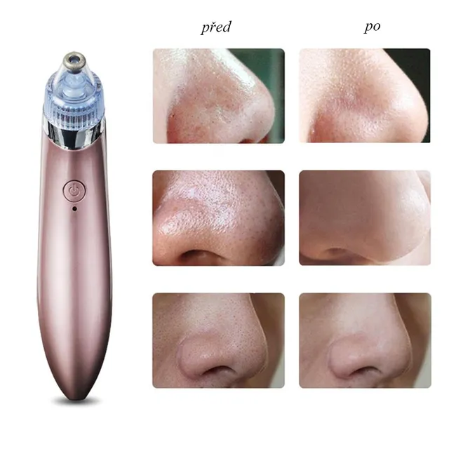 Vacuum Cleaner - removes embedded pores, black dots and acne