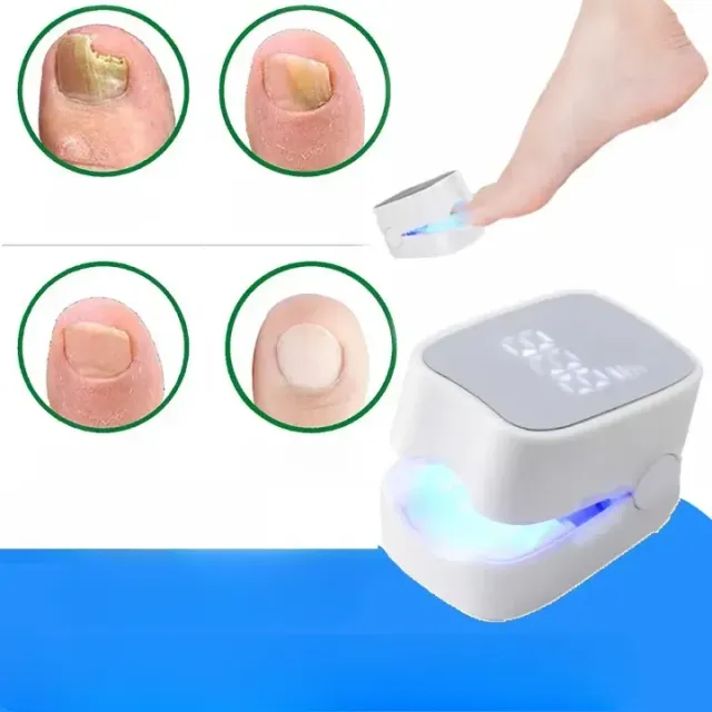 Laser nail cleaning device against mold and onychomycosis Laser finger treatment Cleaning of mold on legs