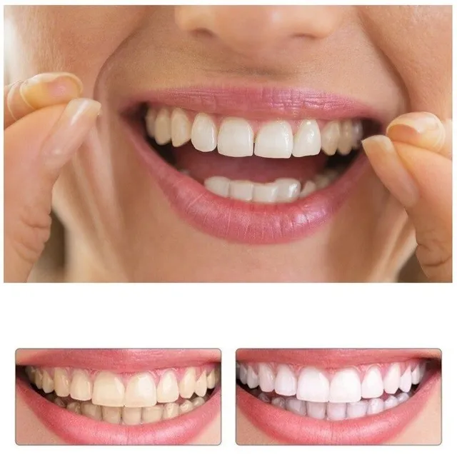 Luxusní sada silikonových zubních protéz pro zářivý úsměv 2 ks Shayla
