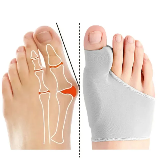 Korrektor für Hallux Valgus mit Zehentrenner für orthopädische Einlagen