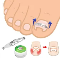 Modern metal toe braces for ingrown toenails Brotes