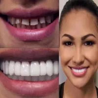 Artificial dentures for a perfect smile (upper and lower)